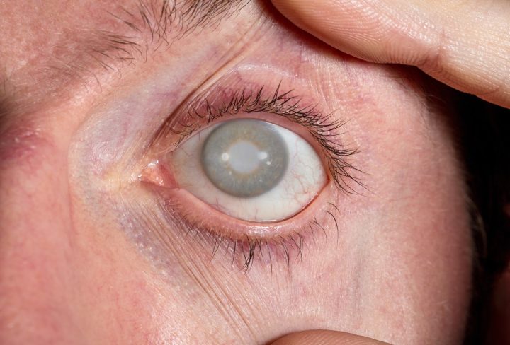 Diabetic Retinopathy